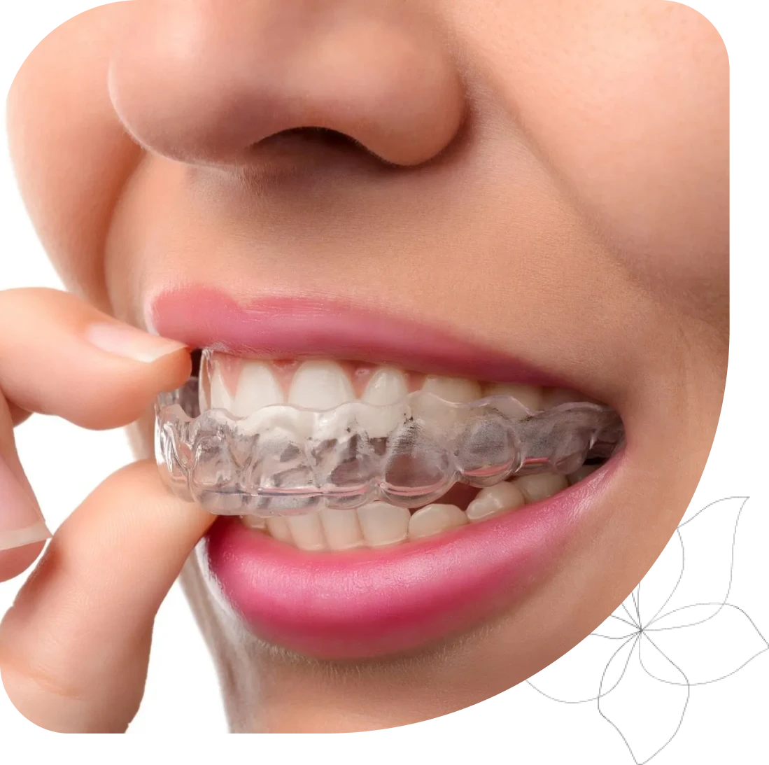 Wearing a clear dental aligner